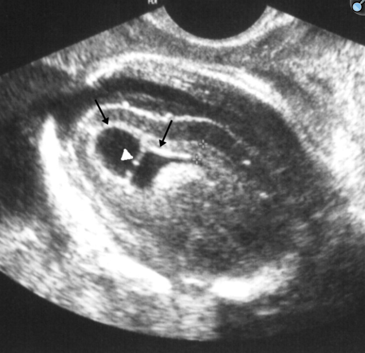 Aderência intraventricular